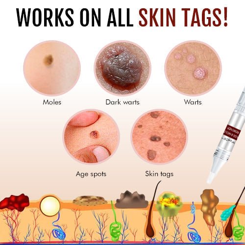 🔥Last Day Promotion 65% OFF🔥𝗤𝗩𝗖 recommends Tags & Moles Remover