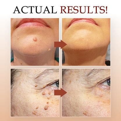 🔥Last Day Promotion 65% OFF🔥𝗤𝗩𝗖 recommends Tags & Moles Remover