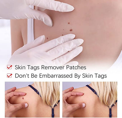 🔥Last Day Promotion 65% OFF🔥𝗤𝗩𝗖 recommends Tags & Moles Remover