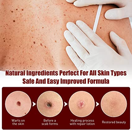 🔥Last Day Promotion 65% OFF🔥𝗤𝗩𝗖 recommends Tags & Moles Remover